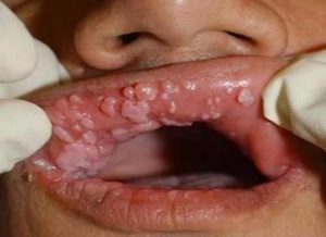 hpv zmiany w jamie ustnej papillómák a gégén